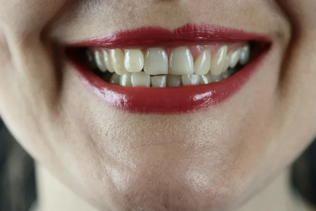 How Much Does Teeth Whitening Cost?