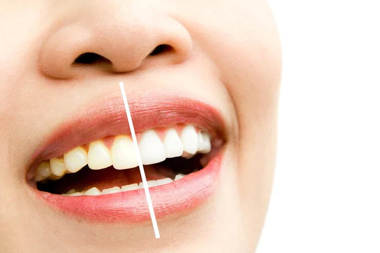Teeth whitening made easy: Best Teeth whitening products